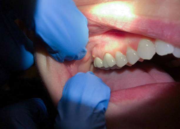 Best Emergency Dental Care for Broken or Chipped Teeth in Albany, GA